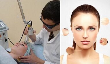 ¿Cómo se realiza el rejuvenecimiento cutáneo con láser